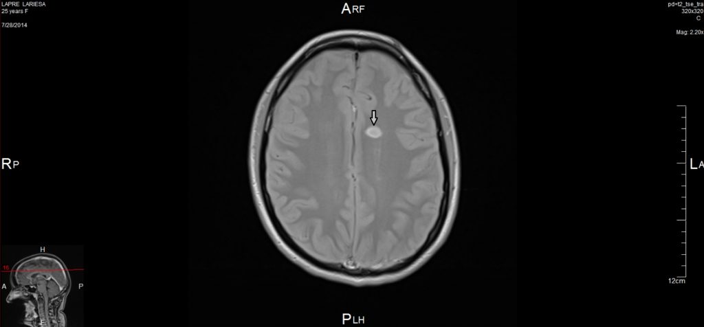 mri-scan-ms
